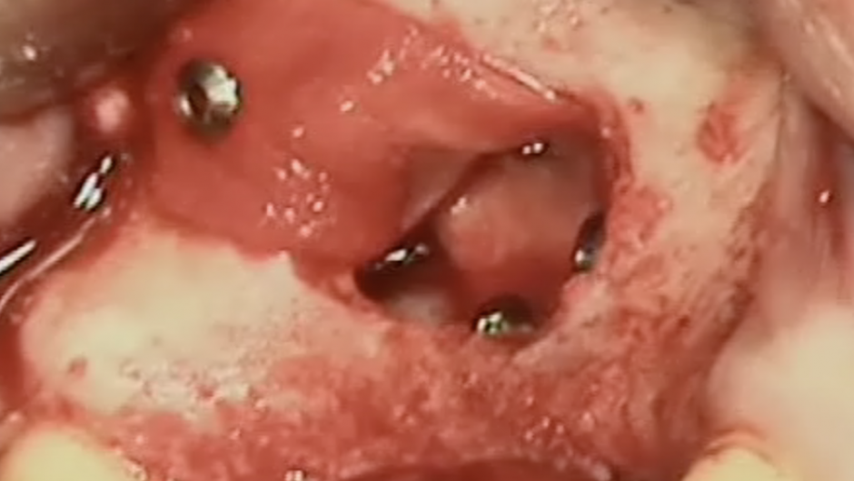 Sinus lift  : 