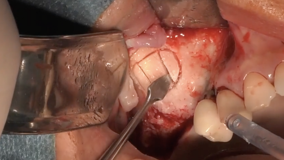 Sinus lift : lateral approach