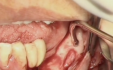 Management alveolar nerve during implant placement