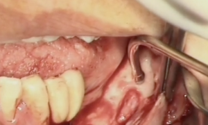 Management alveolar nerve during implant placement