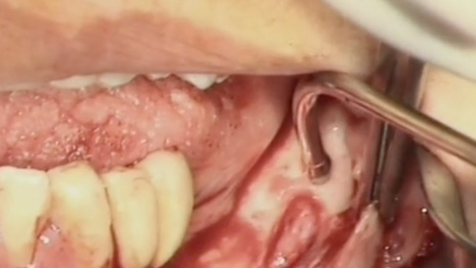 Management alveolar nerve during implant placement