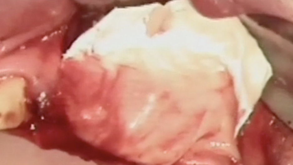 Placement of the bio-oss, fixation of the bio-gide, sutures and placement of the temporary bridge.