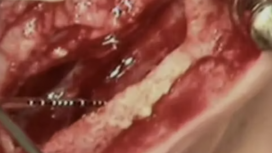 Sinus lift : complication after a failure
