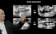 Sinus lift : Patient selection