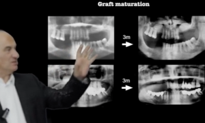 Sinus lift : Patient selection