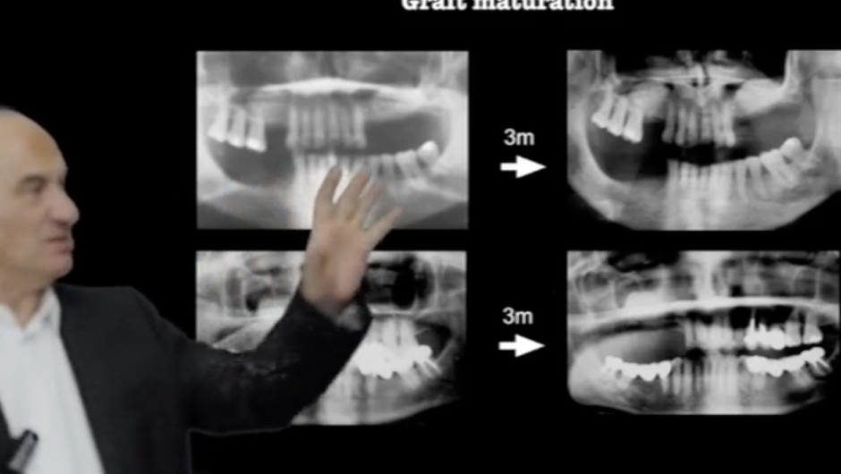 Sinus lift : Patient selection