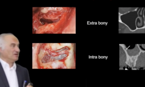 Sinus lift : surgical technique