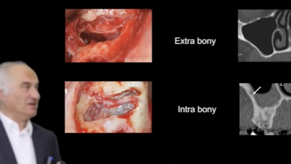 Sinus lift : surgical technique