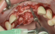 Maxillary expansion : Surgical Technique