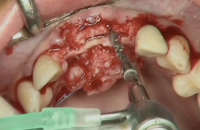 Maxillary expansion : Surgical Technique