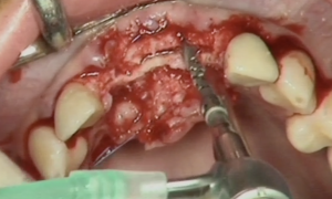 Maxillary expansion : Surgical Technique