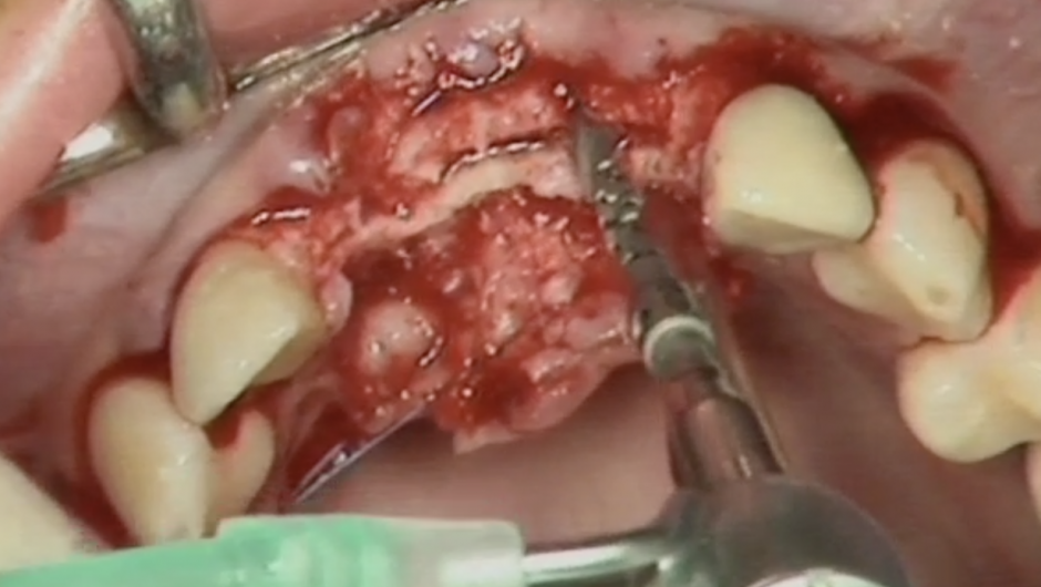 Maxillary expansion : Surgical Technique