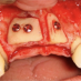 Bone graft by apposition to the maxilla