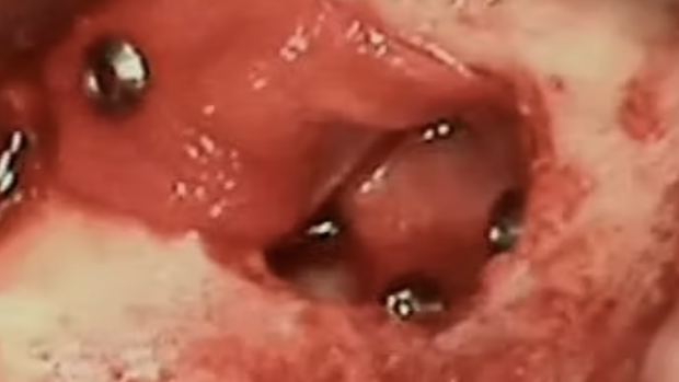 TATTONE TECHNIQUE