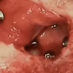 TATTONE TECHNIQUE
